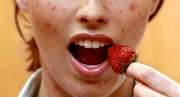 Alergias alimentarias: todo sobre ellas